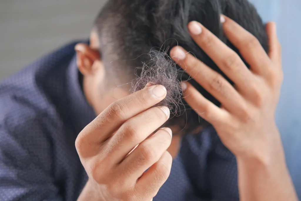 9 Autoimmune Diseases that Cause Hair Loss