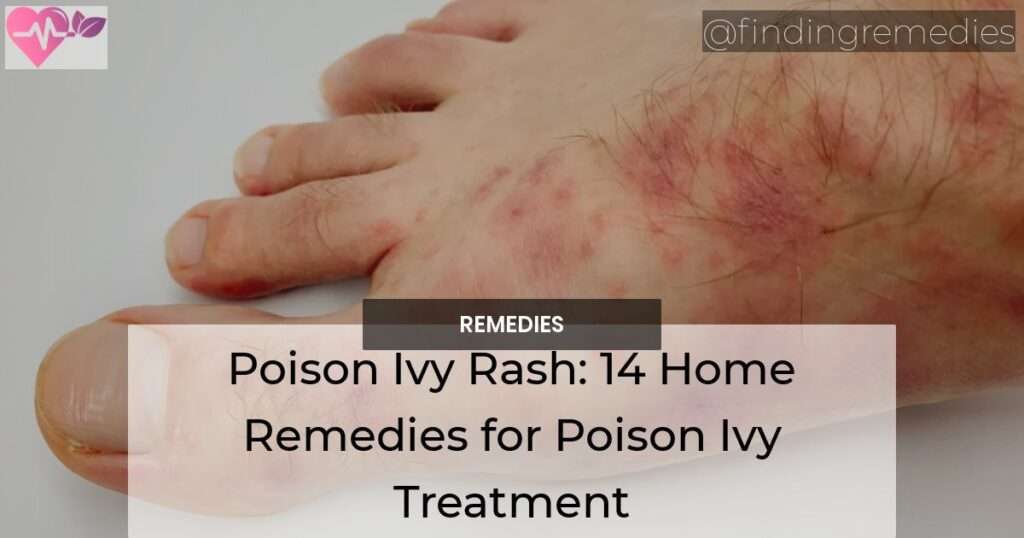 Poison Ivy Rash: 14 Home Remedies for Poison Ivy Treatment - Natural ...